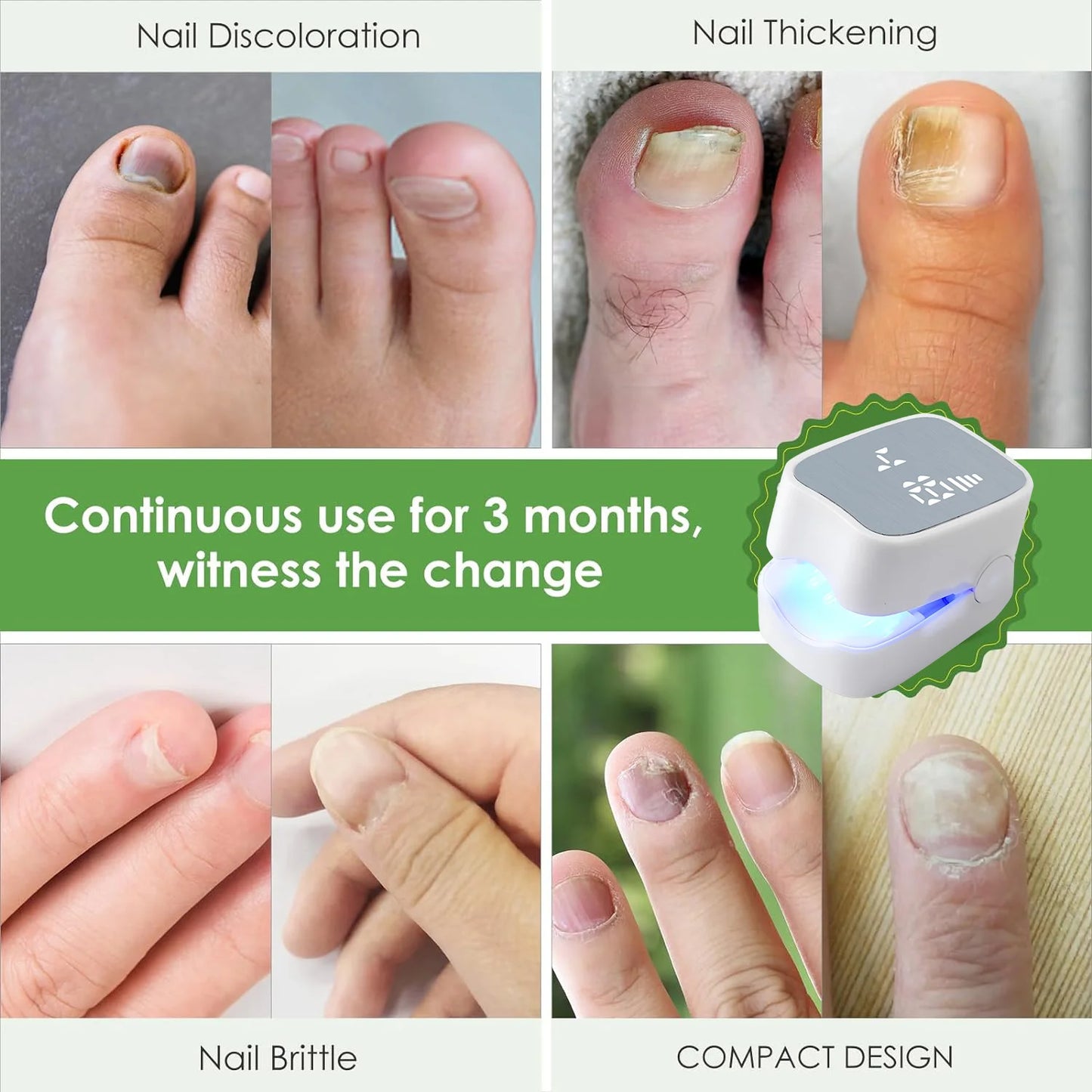 Nail Fungus Laser Assist Tool UV Professional Kynsien sienen puhdistus Laserlaite Kynsien valohoitolamppu Type-C Lataus Tukkukauppa